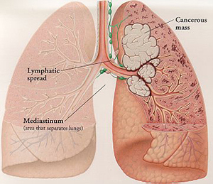 300x259 breathalyser to detect lung cancer - Lung Cancer Drawing