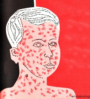 298x329 the validity of vaccines envisioning the american dream - Measles Drawing