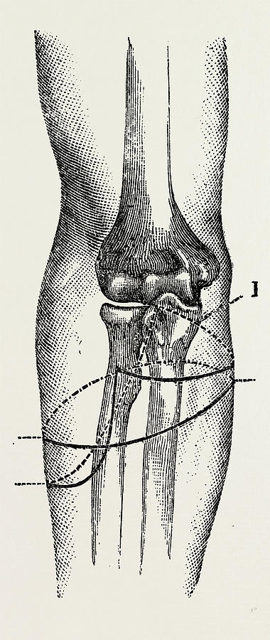 380x900 disarticulation, medical equipment, surgical instrument drawing - Medical Equipment Drawing
