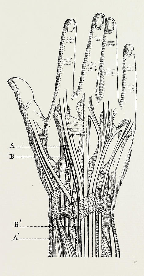 470x900 excision of the wrist, medical equipment drawing - Medical Equipment Drawing