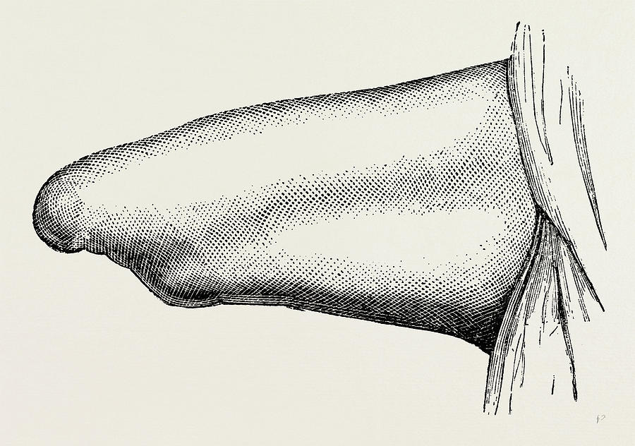 900x632 conical stump following circular, medical equipment drawing - Medical Equipment Drawing