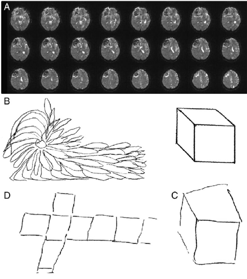 850x959 a right hemispheric lesion - Mri Drawing