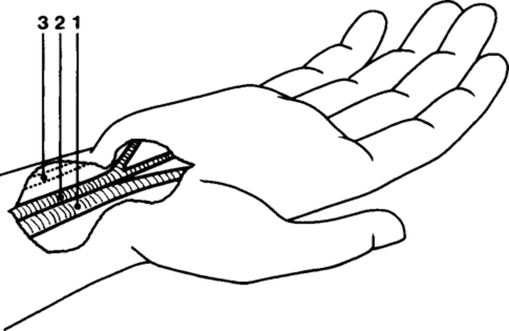 1024x665 atypical carpal tunnel syndrome with compression of the ulnar - Nerve Drawing