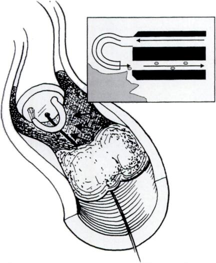 432x526 schematic drawing shows oasis catheter - Oasis Drawing