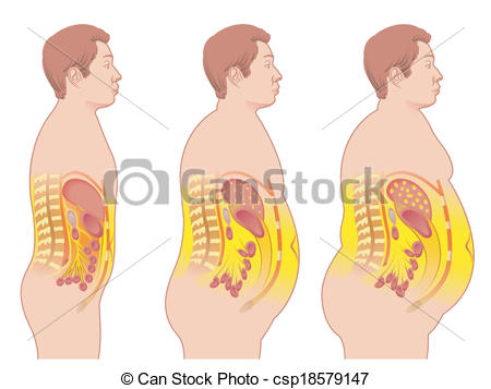 450x357 medical illustration of the consequences of obesity - Obesity Drawing