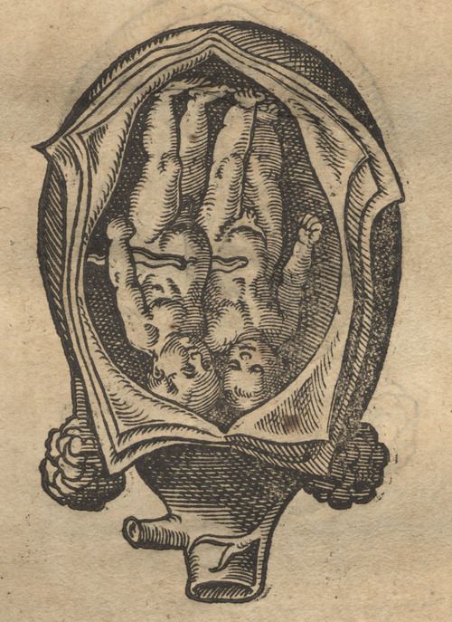 500x687 old medical illustration, twins in utero b medical drawings - Old Drawings