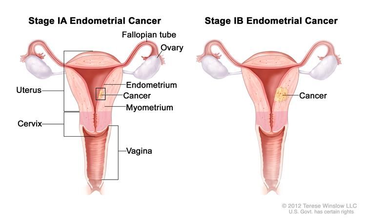 750x452 stage ia and stage ib endometrial cancer shown in two cross - Ovary Drawing
