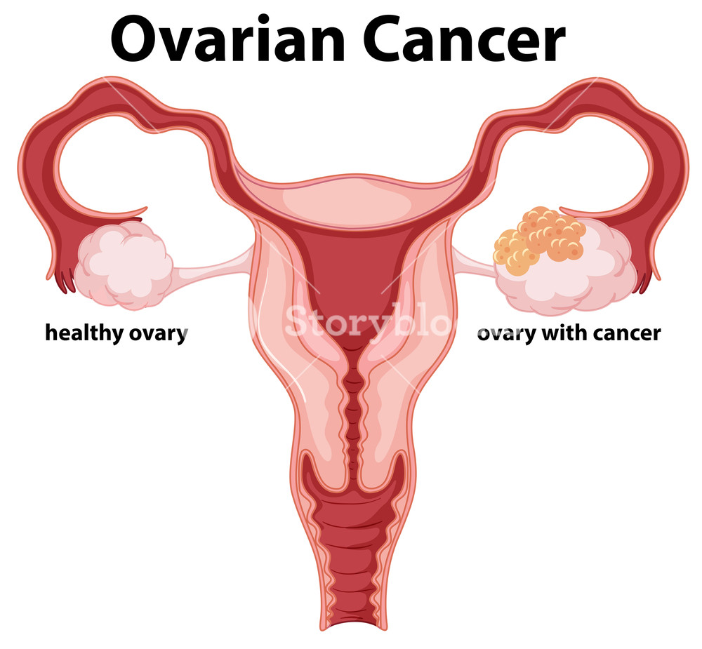 1000x925 Woman Ovarian Cancer Concept Drawing Royalty Free Stock Image - Ovary Drawing