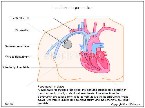 500x375 Insertion Of A Pacemaker Illustrations - Pacemaker Drawing