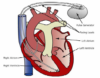 319x249 Pacemaker - Pacemaker Drawing