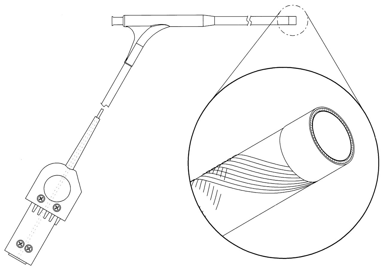 1280x901 pacemaker lead extraction with the laser sheath results - Pacemaker Drawing