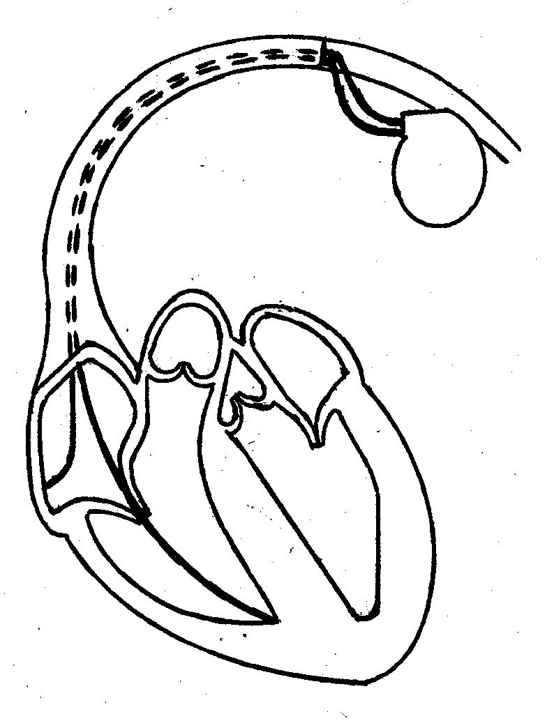 794x1034 The Fantastic Pacemaker System Sid Deutsch Writes - Pacemaker Drawing