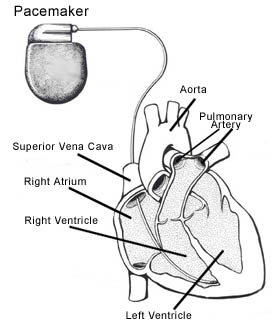 275x326 florida cardiopulmonary center pacemaker - Pacemaker Drawing