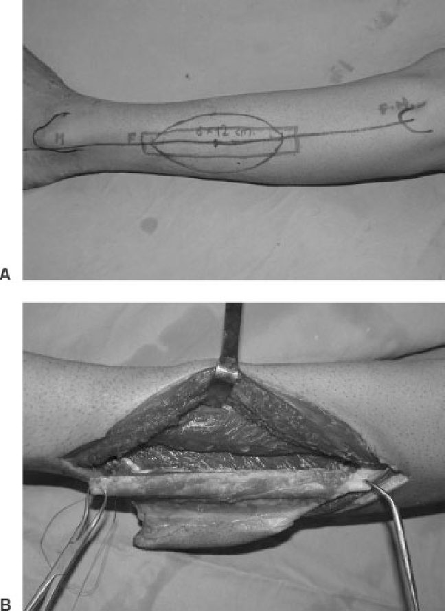 648x890 operative stage - Paddle Drawing