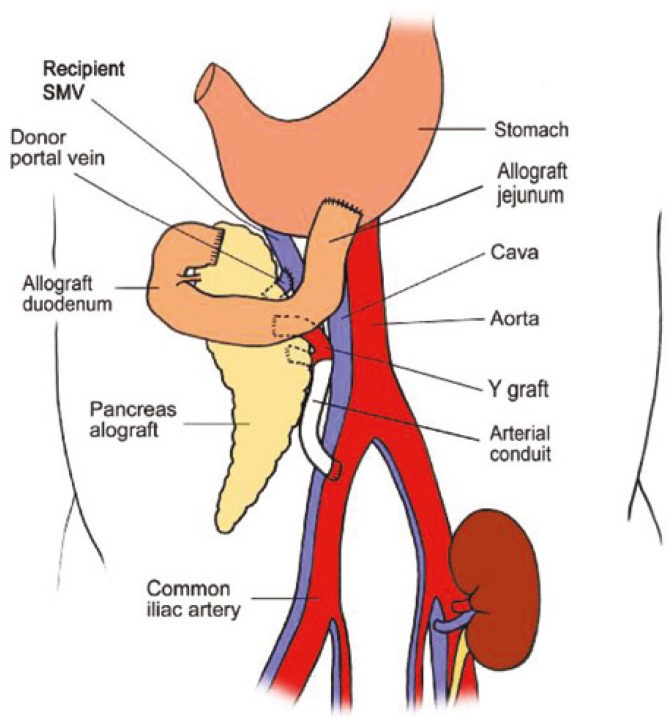 668x718 schematic drawing of the portal gastric technique for pancreas - Pancreas Drawing