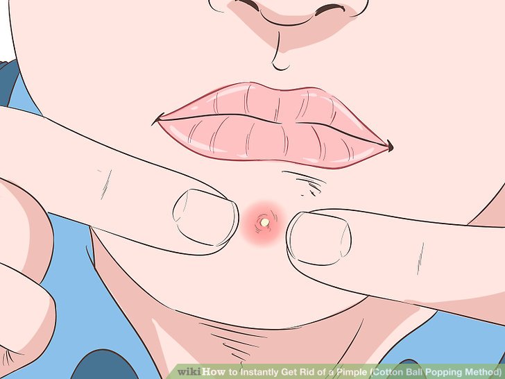 728x546 how to instantly get rid of a pimple - Pimple Drawing