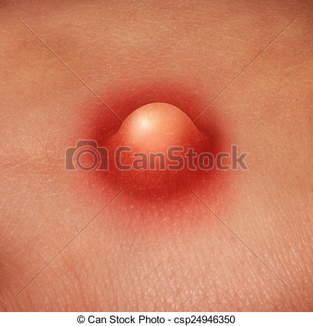 450x468 pimple on skin pimple on human skin as a medical and dermatology - Pimple Drawing