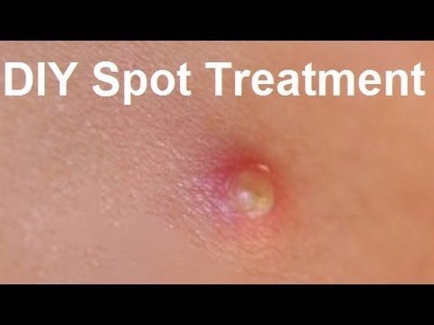 480x360 diy treatment for pus filled spots - Pimple Drawing