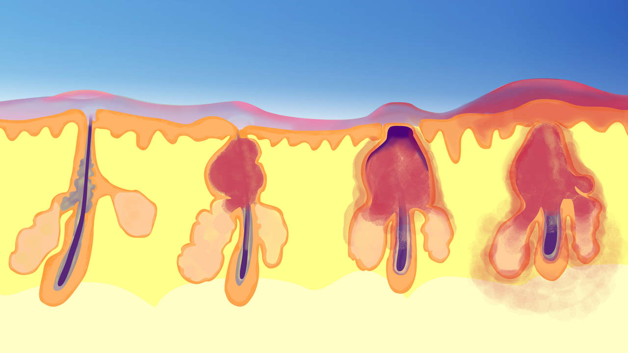 1280x720 dr pimple popper's advice for how to get rid of acne - Pimple Drawing