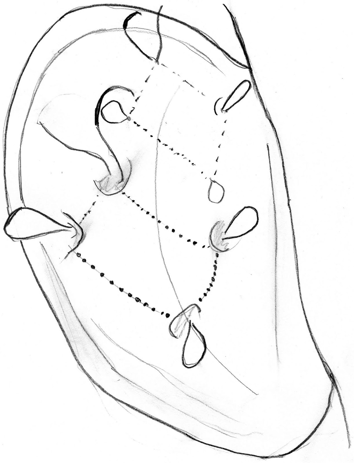 1222x1600 Mcq's In Facial Plastic Reconstructive Surgery - Plastic Surgery Drawing