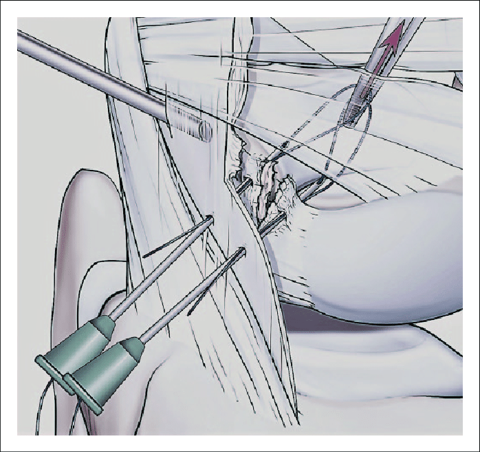 698x657 drawing of suture retrieval using a hemostat introduced through - Portal Drawing