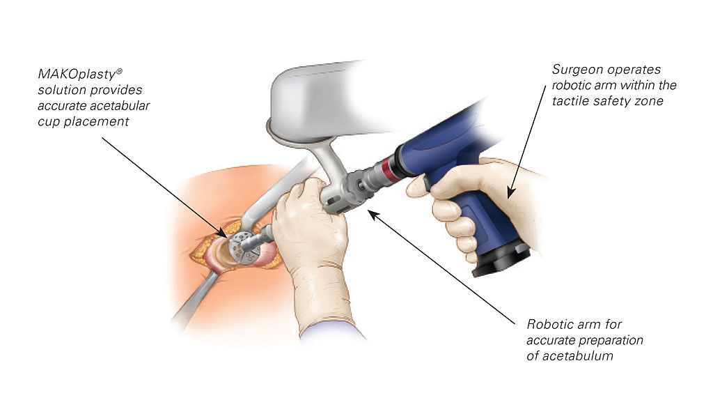 1024x584 Filemakoplasty Procedure Drawing W Lables - Procedure Drawing