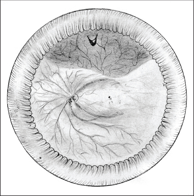 650x657 retinal physician - Retinal Drawing