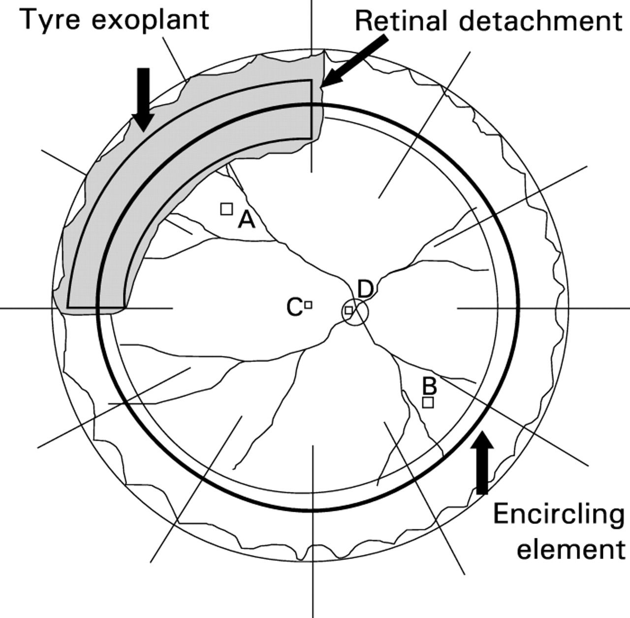 1280x1256 effects of scleral buckling and encircling procedures on human - Retinal Drawing