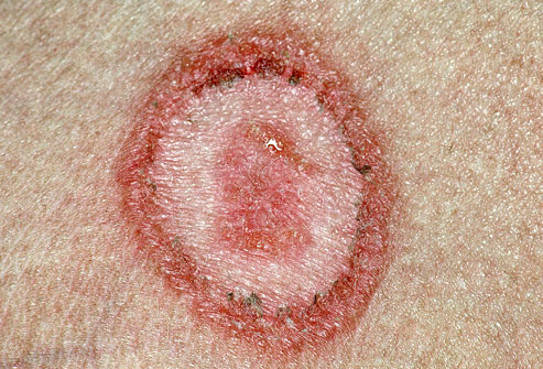 493x335 Picture Of Ringworm Of The Body - Ringworm Drawing