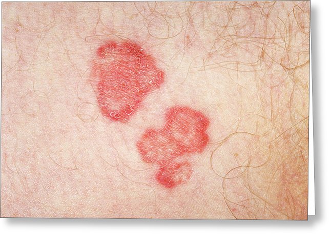 646x470 Ringworm Photograph - Ringworm Drawing