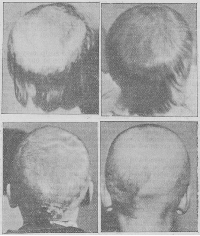 662x782 The Ringworm Irradiators - Ringworm Drawing