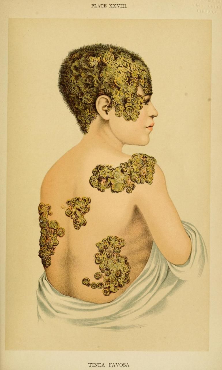 770x1280 tinea favosa tinea favosa is the ringworm fungus that affects both - Ringworm Drawing