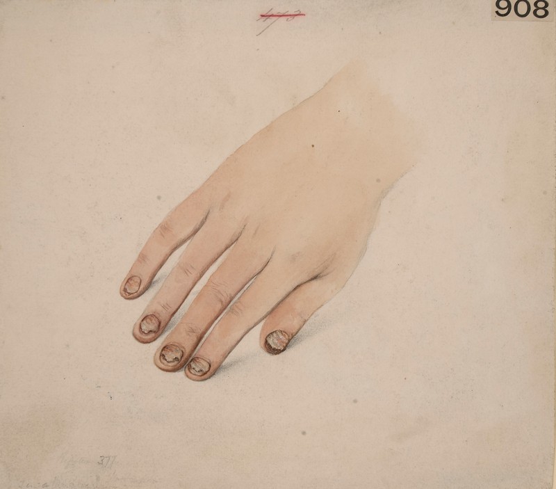 800x703 Tinea Ungium - Ringworm Drawing