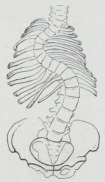 340x589 scoliosis - Scoliosis Drawing