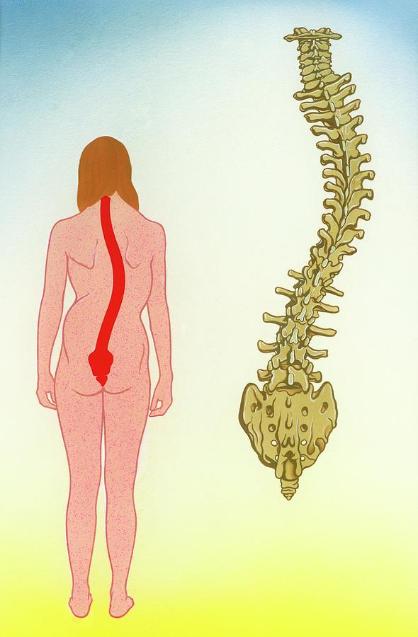590x900 scoliosis photograph - Scoliosis Drawing