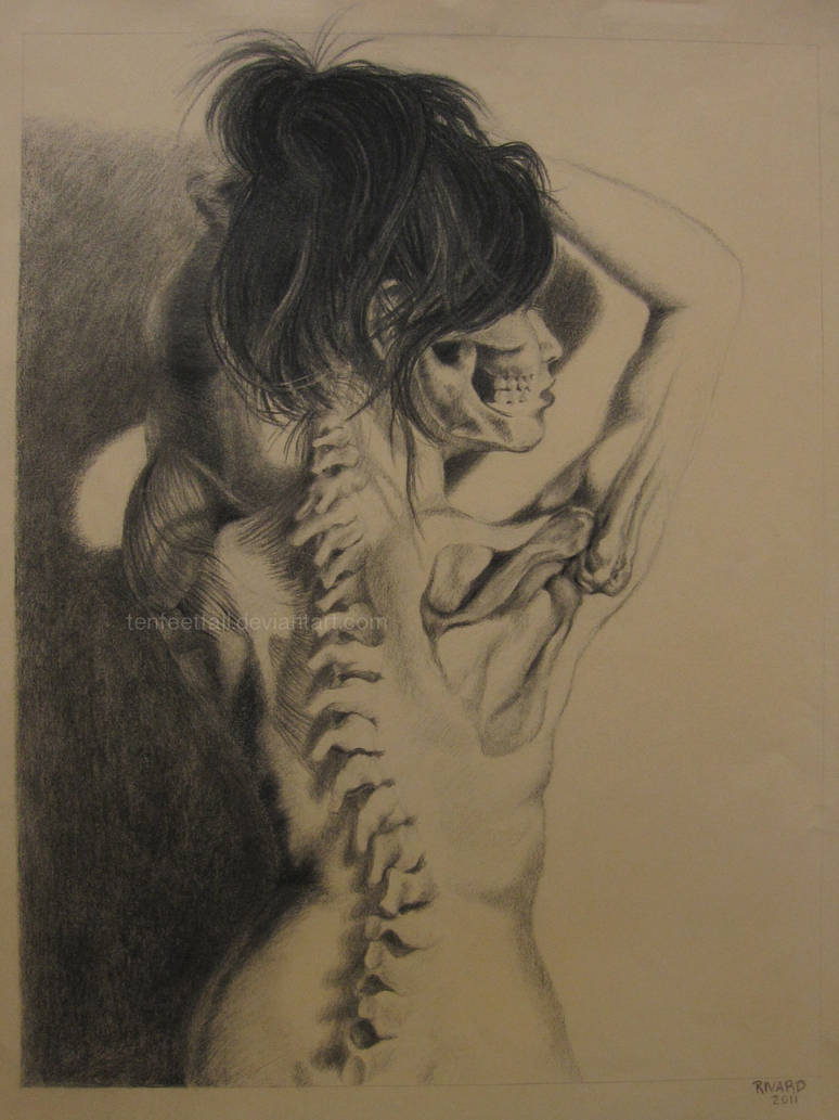 774x1033 scoliosis - Scoliosis Drawing