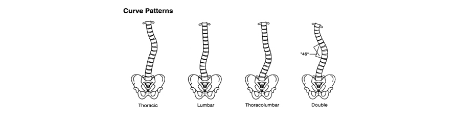 894x241 scoliosis - Scoliosis Drawing