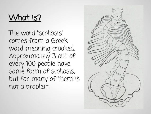 638x479 scoliosis - Scoliosis Drawing