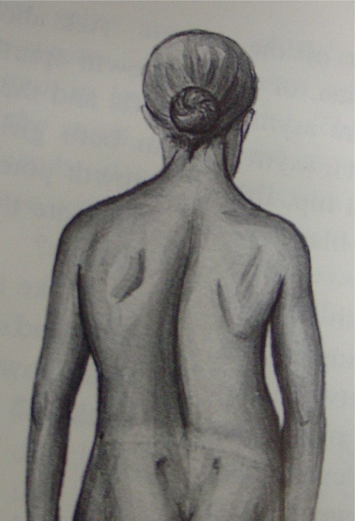 511x750 the spine scoliosis center - Scoliosis Drawing