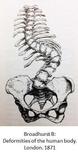 275x536 the spine surgery will help your child breathe about bone - Scoliosis Drawing