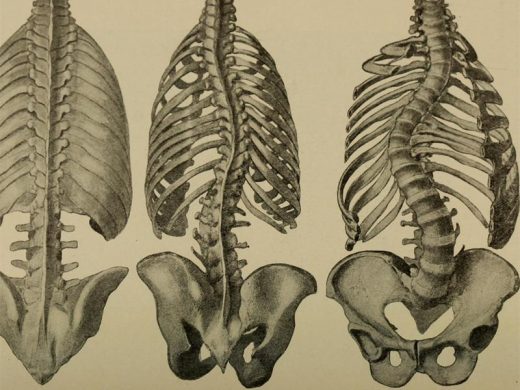 520x390 understanding scoliosis randburg sun - Scoliosis Drawing