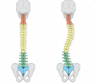 325x290 very short term practice of a simple yoga pose reduces adolescent - Scoliosis Drawing