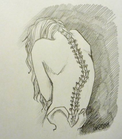 424x485 scoliosis - Scoliosis Drawing
