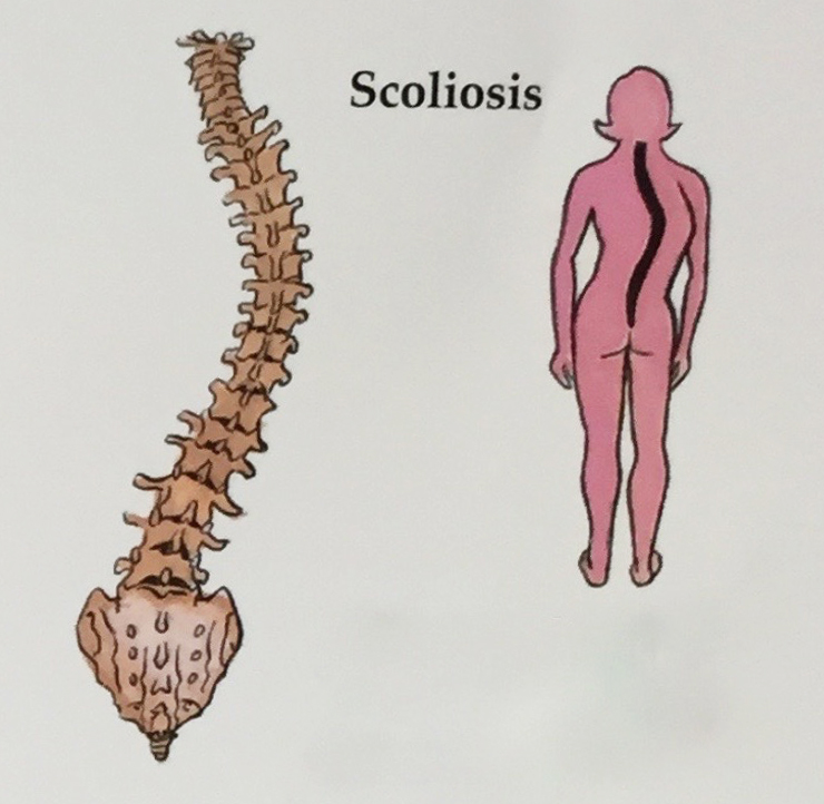 740x722 adult scoliosis - Scoliosis Drawing