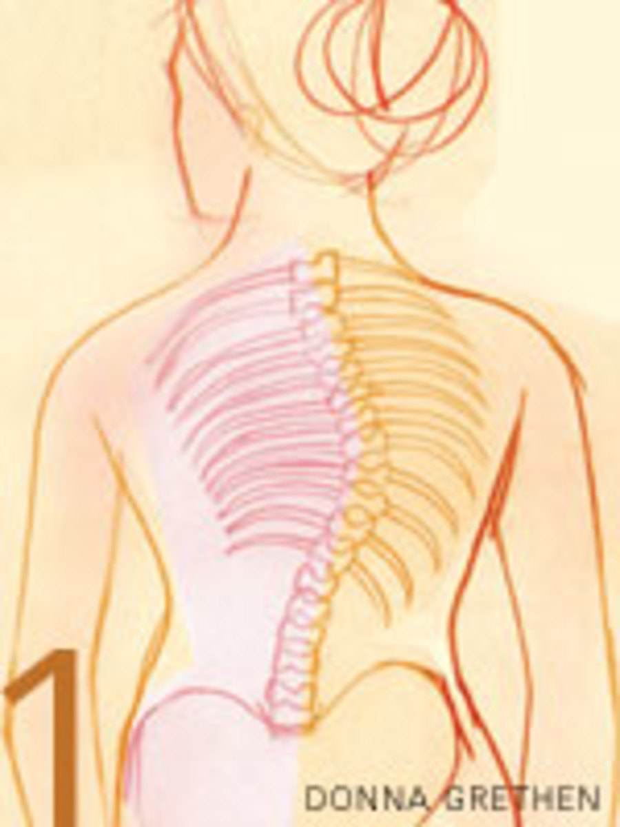 Scoliosis Drawing at Explore collection of