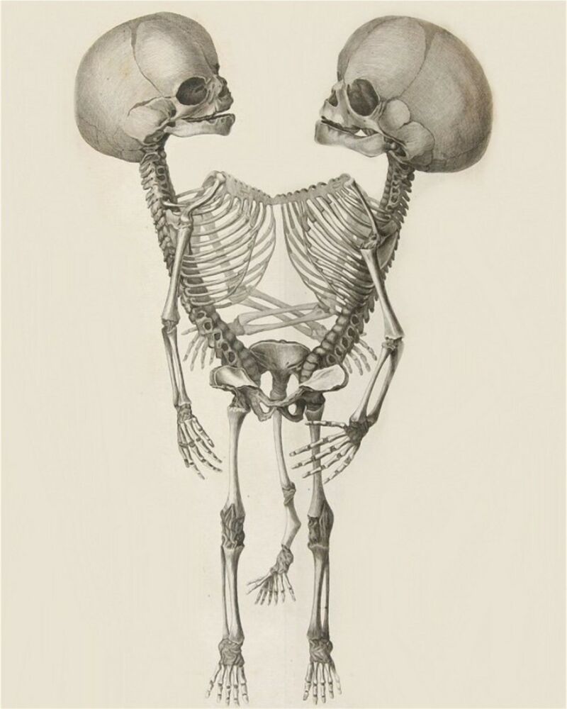 800x1000 skeleton siamese twins art print x - Siamese Twins Drawing