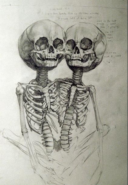 422x612 Conjoined Twins, Grotesque Yet Beautiful Anatomy Art, Dark Art - Siamese Twins Drawing