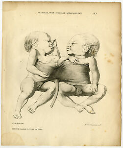 251x300 antique print miscarriage siamese twins human sheep vrolik meijer - Siamese Twins Drawing