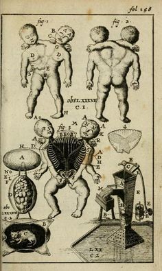 236x395 siamese twin drawing - Siamese Twins Drawing
