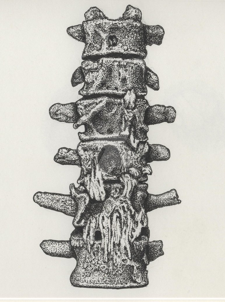 772x1036 pathological portion of spine - Skeleton Spine Drawing
